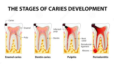 dentalcaries