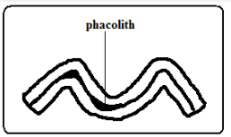 phacolith.PNG